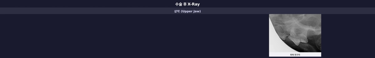 수술 후 잔존 뿌리 없이 깔끔하게 발치 및 보존 치료된 치아 X-ray