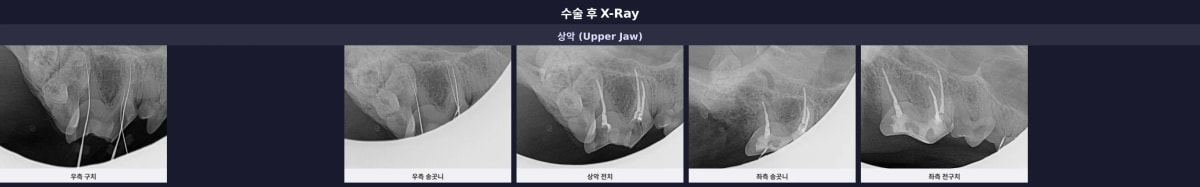 수술 후 X-Ray 결과