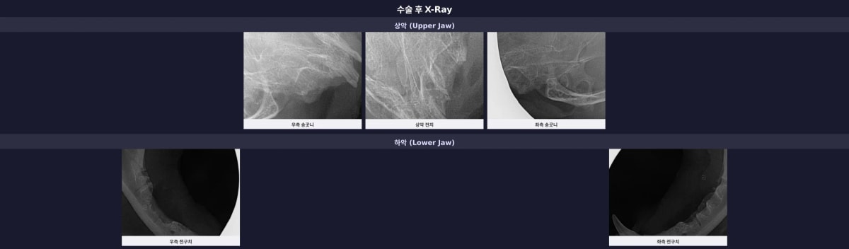 수술 후 치과 X-Ray