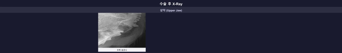 수술 후 104번 치아 뿌리까지 완벽하게 제거된 엑스레이 소견