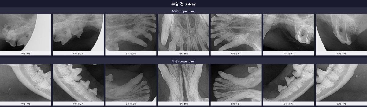 수술 전 치과 엑스레이로 확인한 심각한 치조골 소실 및 과거 신경치료 보존 부위