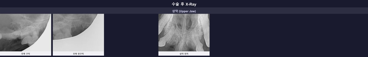 잔존 뿌리 없이 완벽하게 발치되고 엠도게인 재생 치료가 완료된 수술 후 엑스레이