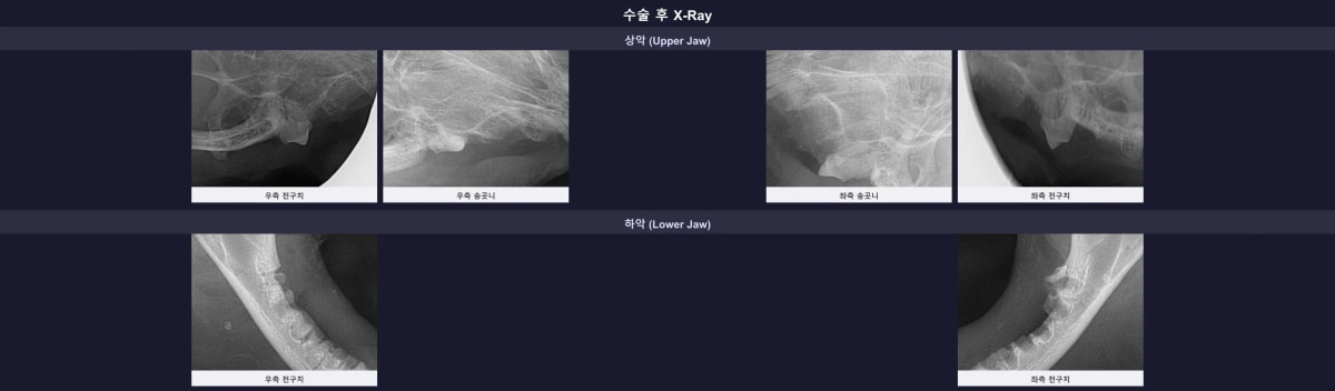 잔존 치근 없이 깔끔하게 마무리된 수술 후 엑스레이