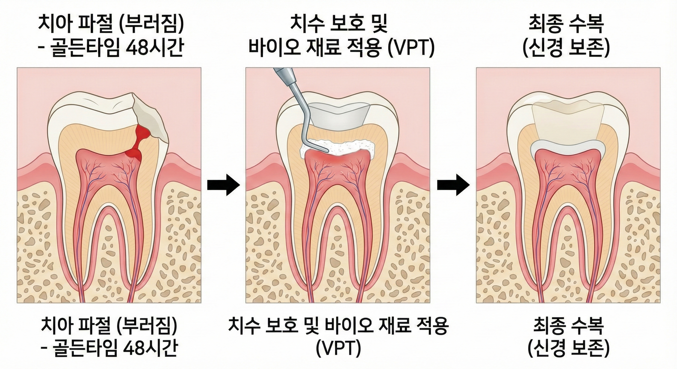부분신경치료