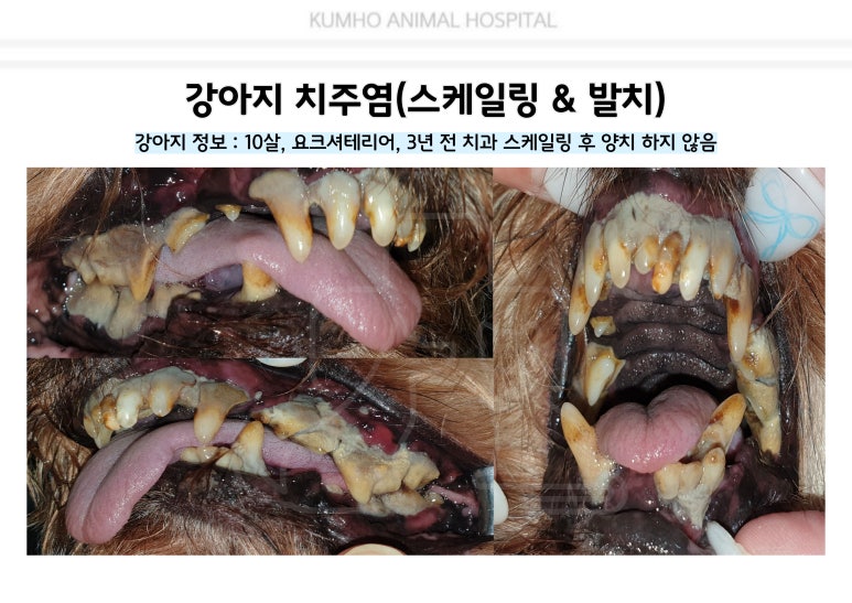 치주염 치료