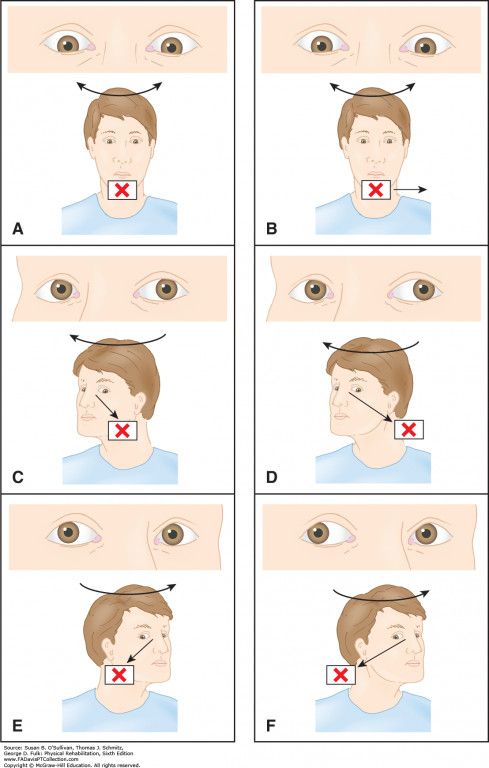 clinicol-vestibular-migraine-2.jpeg