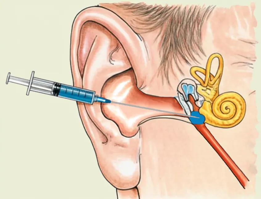 clinicol-sudden-sensorineural-hearing-loss-2.webp