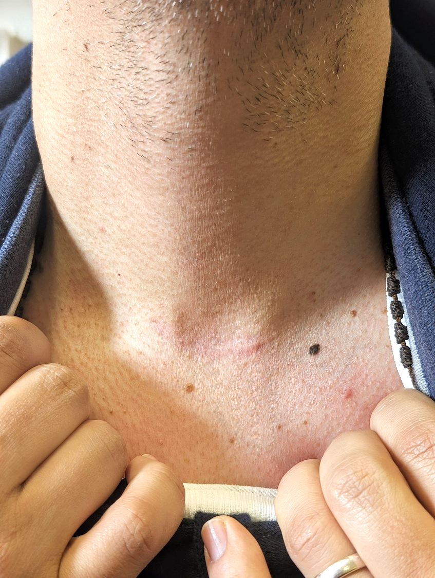 clinicol-total-thyroidectomy-3.png