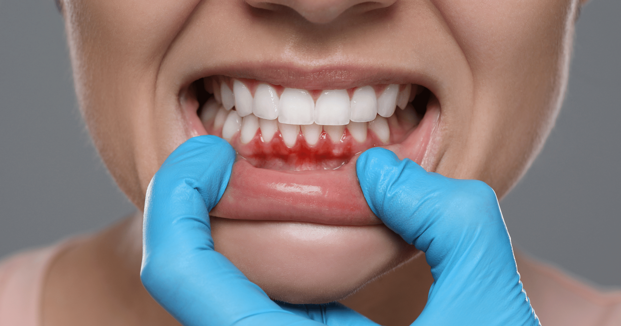 İşaretleri görmezden gelmeyin. Diş eti hastalığının (gingivitis ve periodontitis) belirtilerini tanımayı ve onu önlemek için basit ama etkili adımları öğrenin.