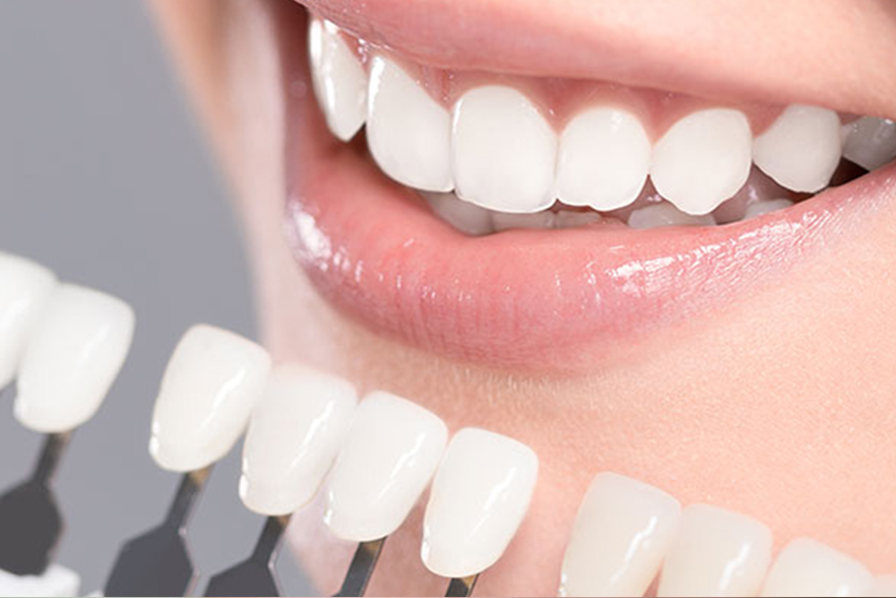 Natural-looking, bright zirconium crowns after treatment.