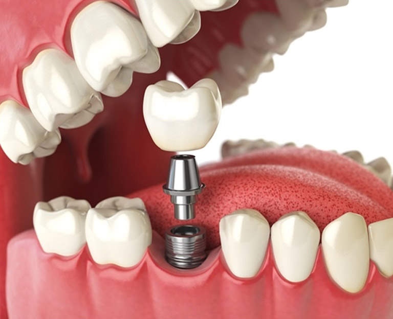 Diş implantlarının eksik dişler için nasıl kalıcı, güvenilir ve estetik bir çözüm sunduğunu, gülüşünüzün fonksiyonunu ve doğal görünümünü nasıl geri kazandırdığını öğrenin.