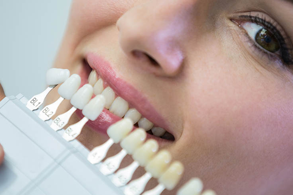 Perfectly aligned and white teeth after laminate veneers.