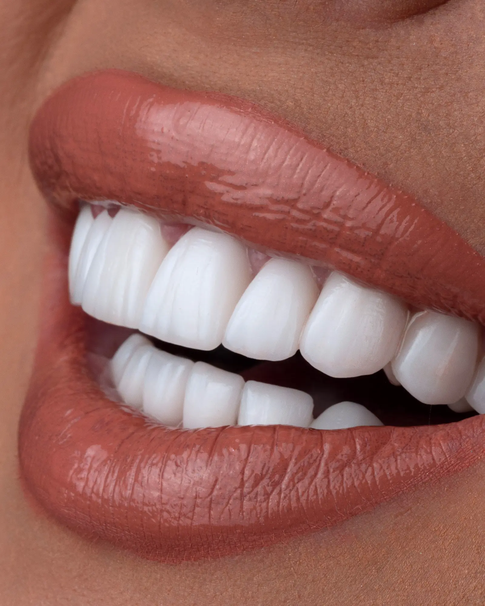 Zâmbet cu fațete dentare