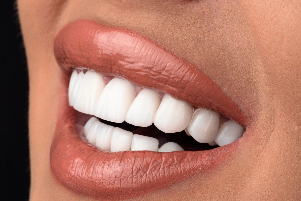 Zâmbet perfect cu fațete ceramice