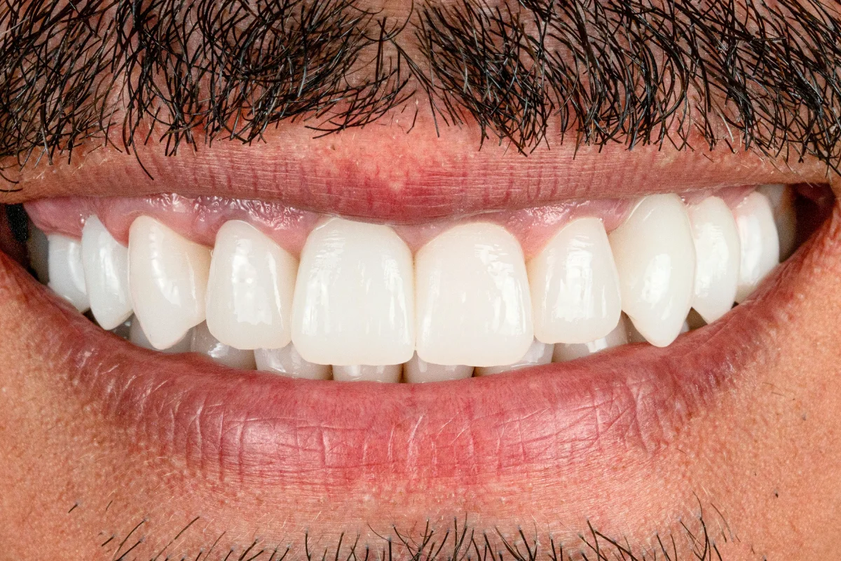 Apropiere a fațetelor ceramice