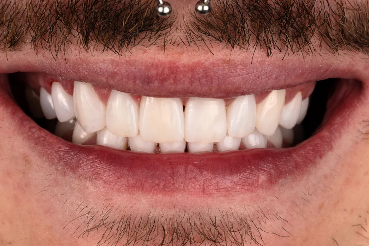 Alt zâmbet frumos cu fațete