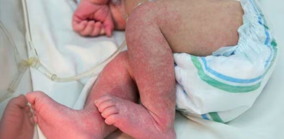 Bebê com chikungunya – imagem ilustrativa