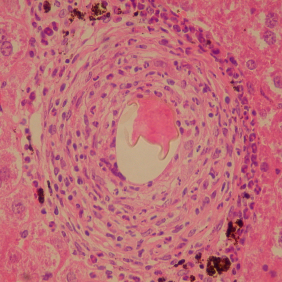  Granuloma hepático reacional a presença de ovo de  Schistosoma mansoni  