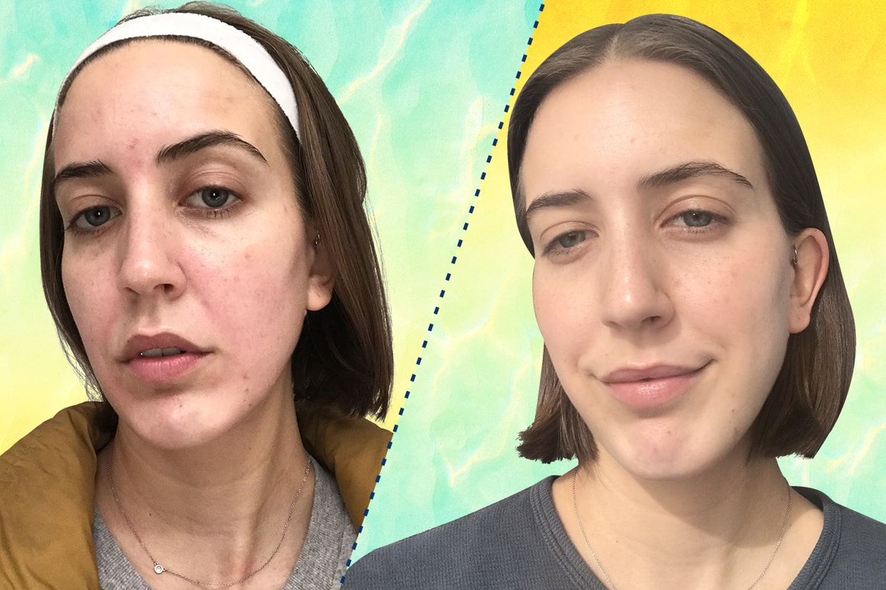 Editor Savannah Scott before and after p50 facial