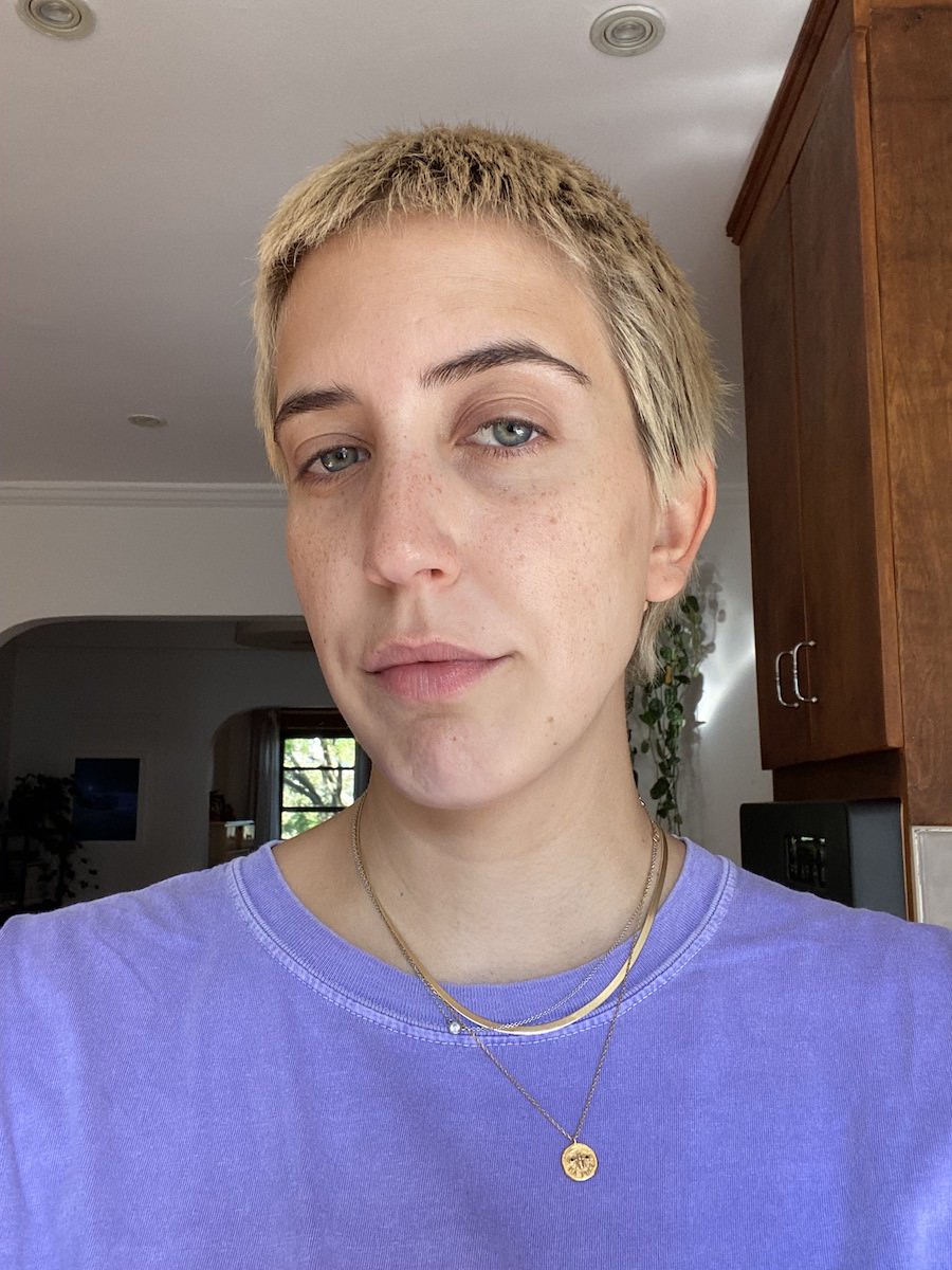 One week later—no irritation