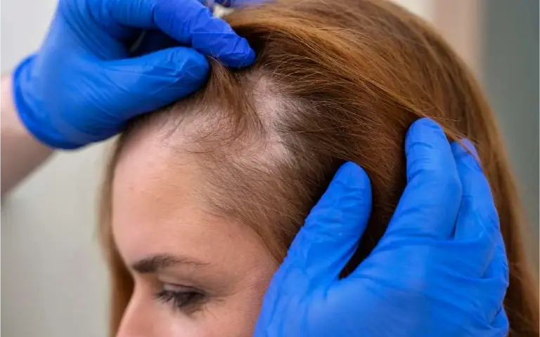 Retka kosa na temenu glave