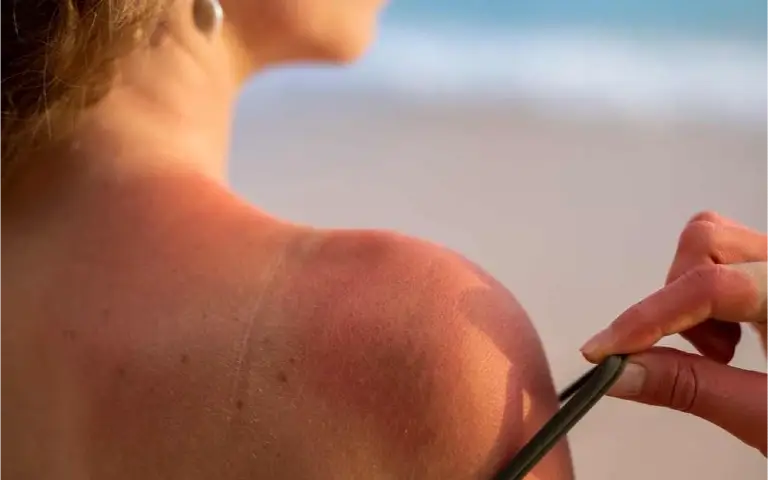 Opekotine od sunca Žena na plaži pozira sa opekotinama