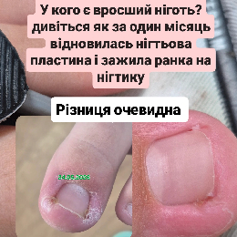 Допомогаю відновити нігтьову пластину і не відчувати біль