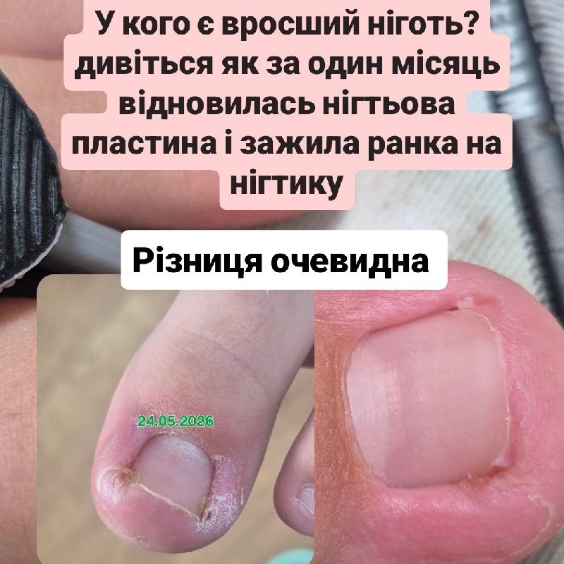 Допомогаю відновити нігтьову пластину і не відчувати біль