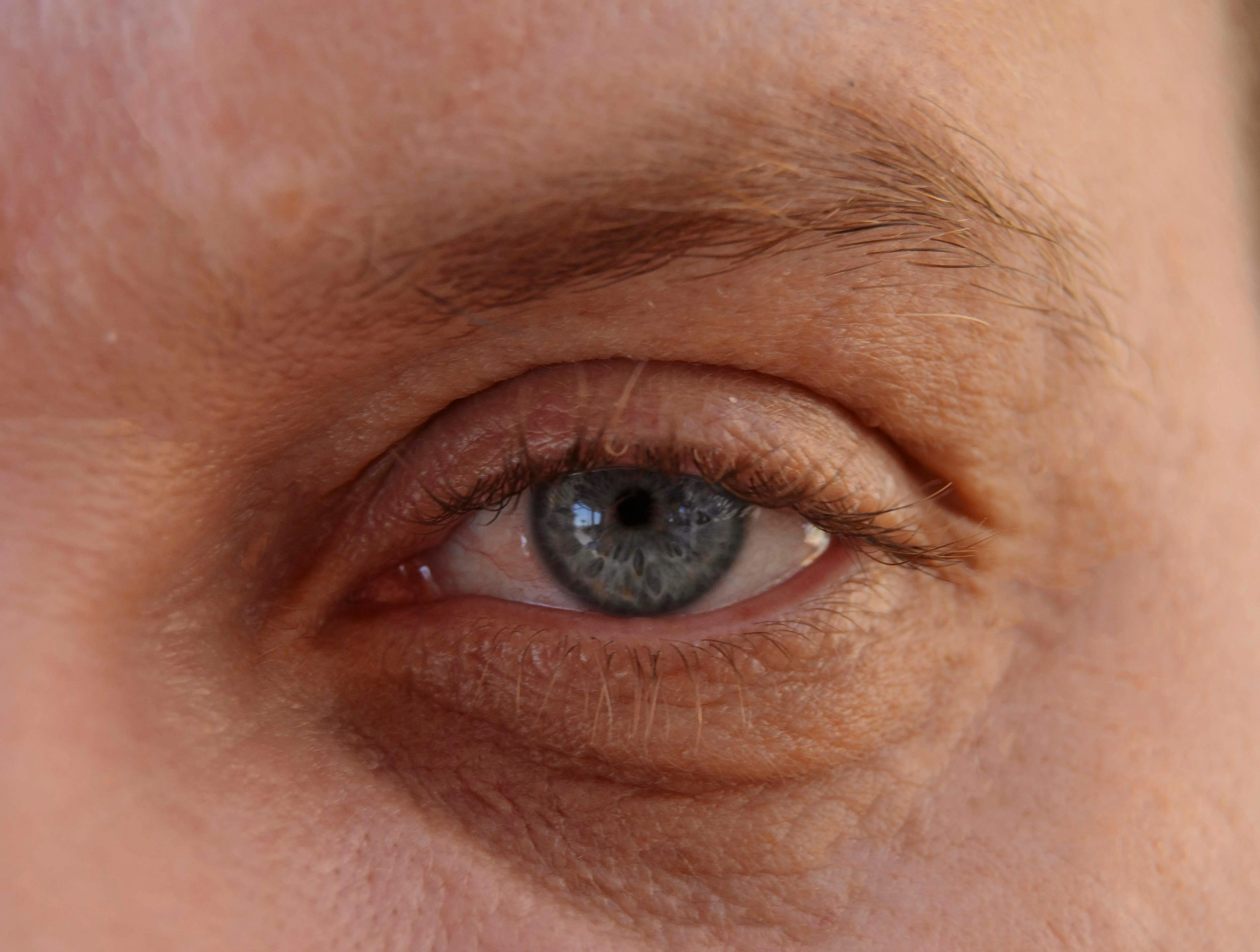 Dry Eye