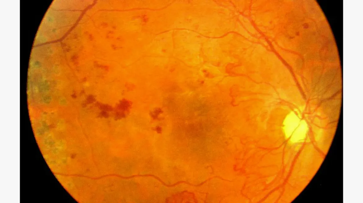 Diabetic Retinopathy