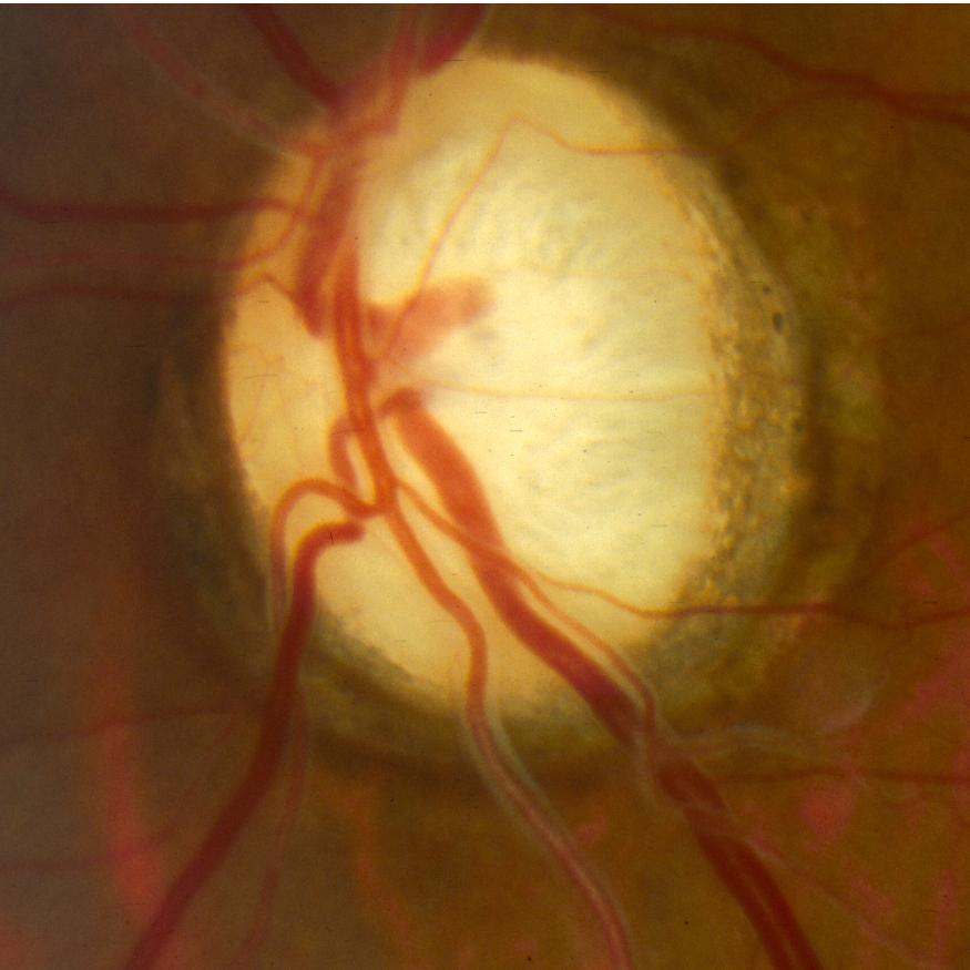 Glaucoma