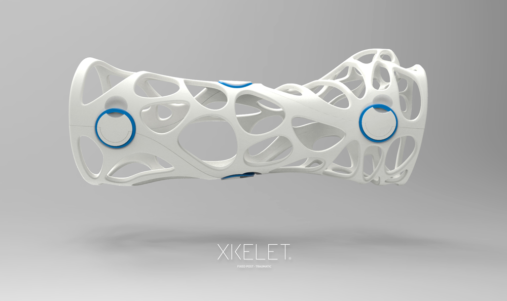 Una 'start-up' española está a punto de revolucionar las escayolas con impresión 3D