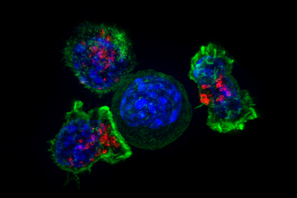 Un humano recibe células modificadas genéticamente con CRISPR por primera vez