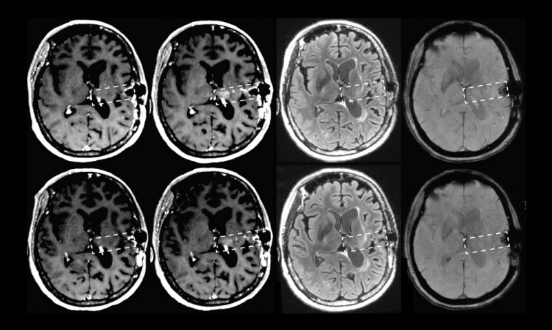 Esta máquina predice el riesgo de alzhéimer con más precisión que los médicos