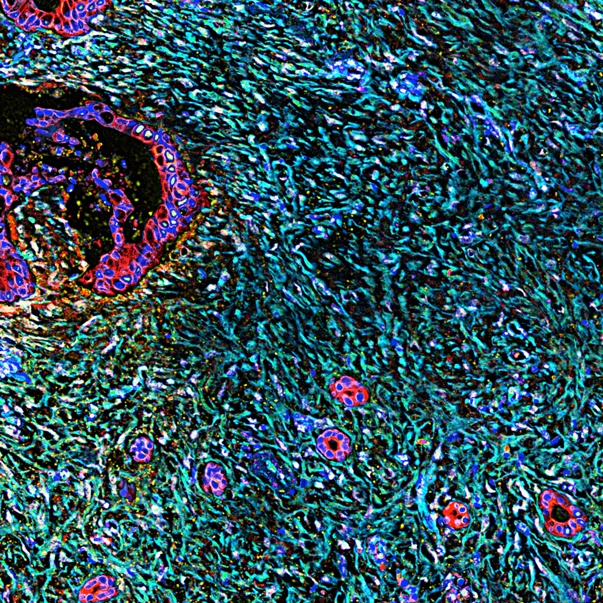 Una partícula del prepucio modificada detiene el cáncer de páncreas en ratones
