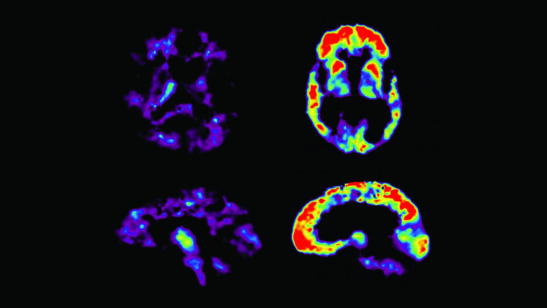 Los fármacos antialzhéimer siguen fracasando y la ciencia ya no sabe qué hacer