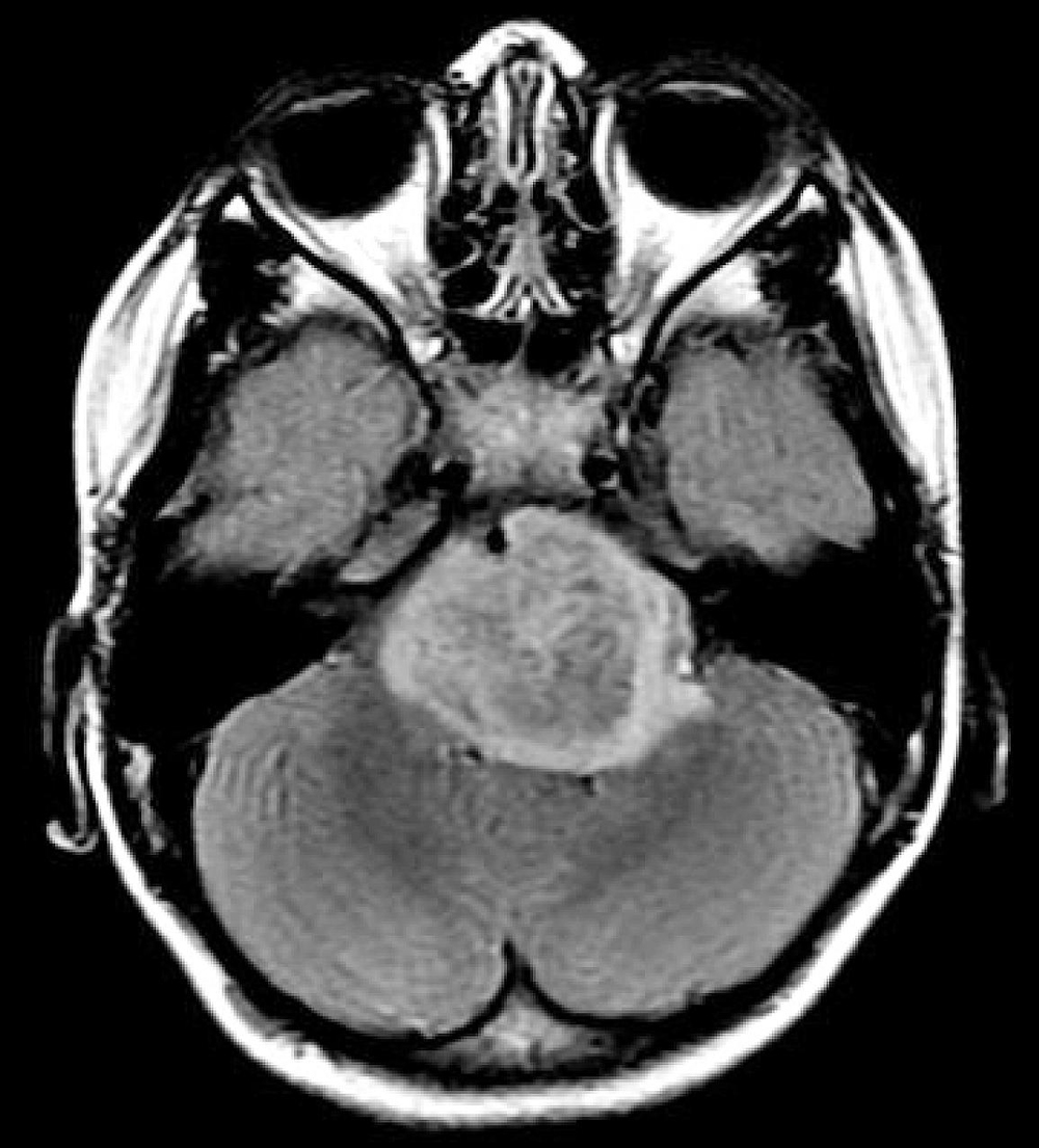 Medicina personalizada genética para ganar la batalla del cáncer cerebral infantil