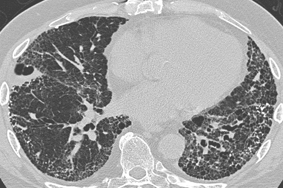 Un millón de dólares para quien consiga detectar el cáncer de pulmón con inteligencia artificial
