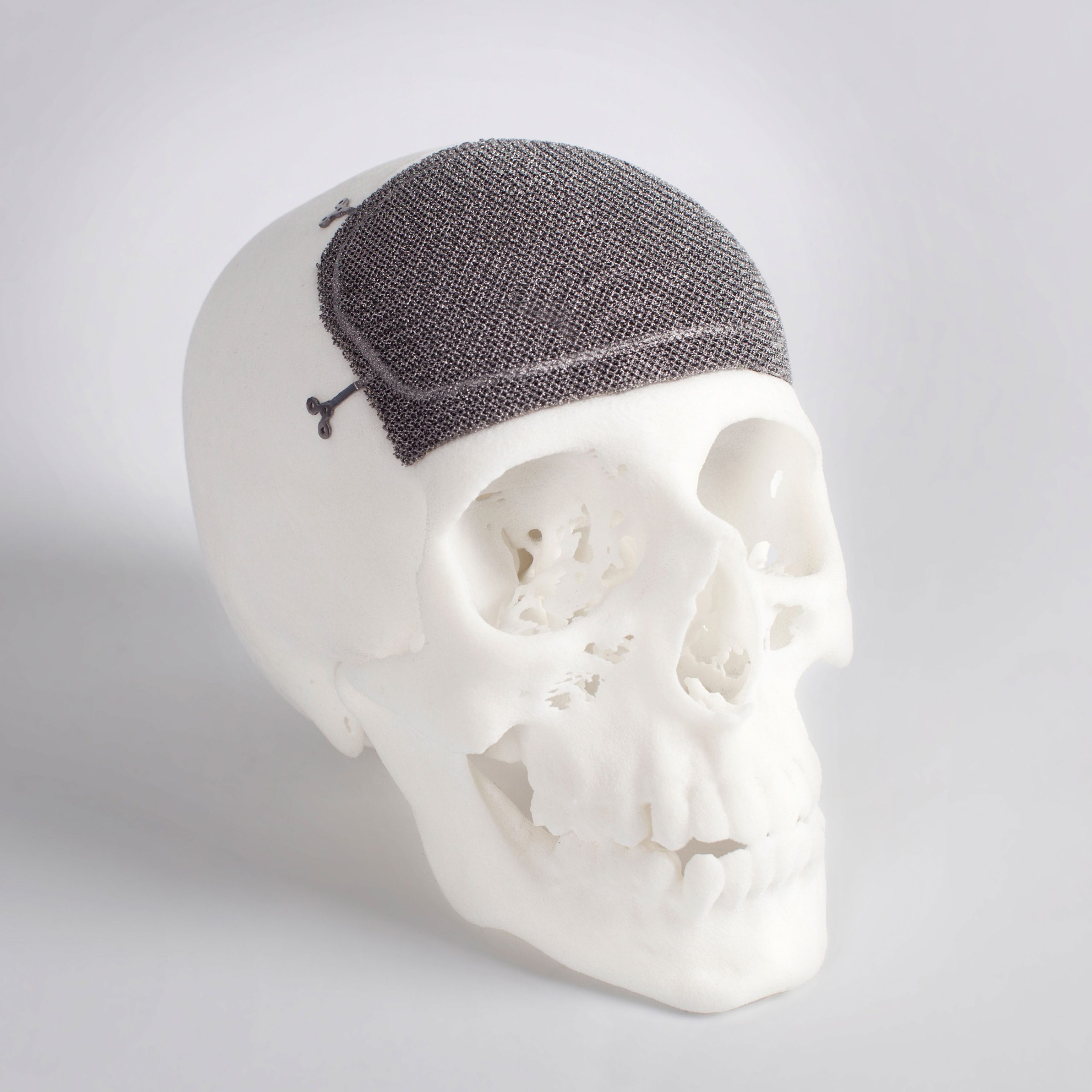 La era de las prótesis ortopédicas personalizadas impresas en 3D está cerca