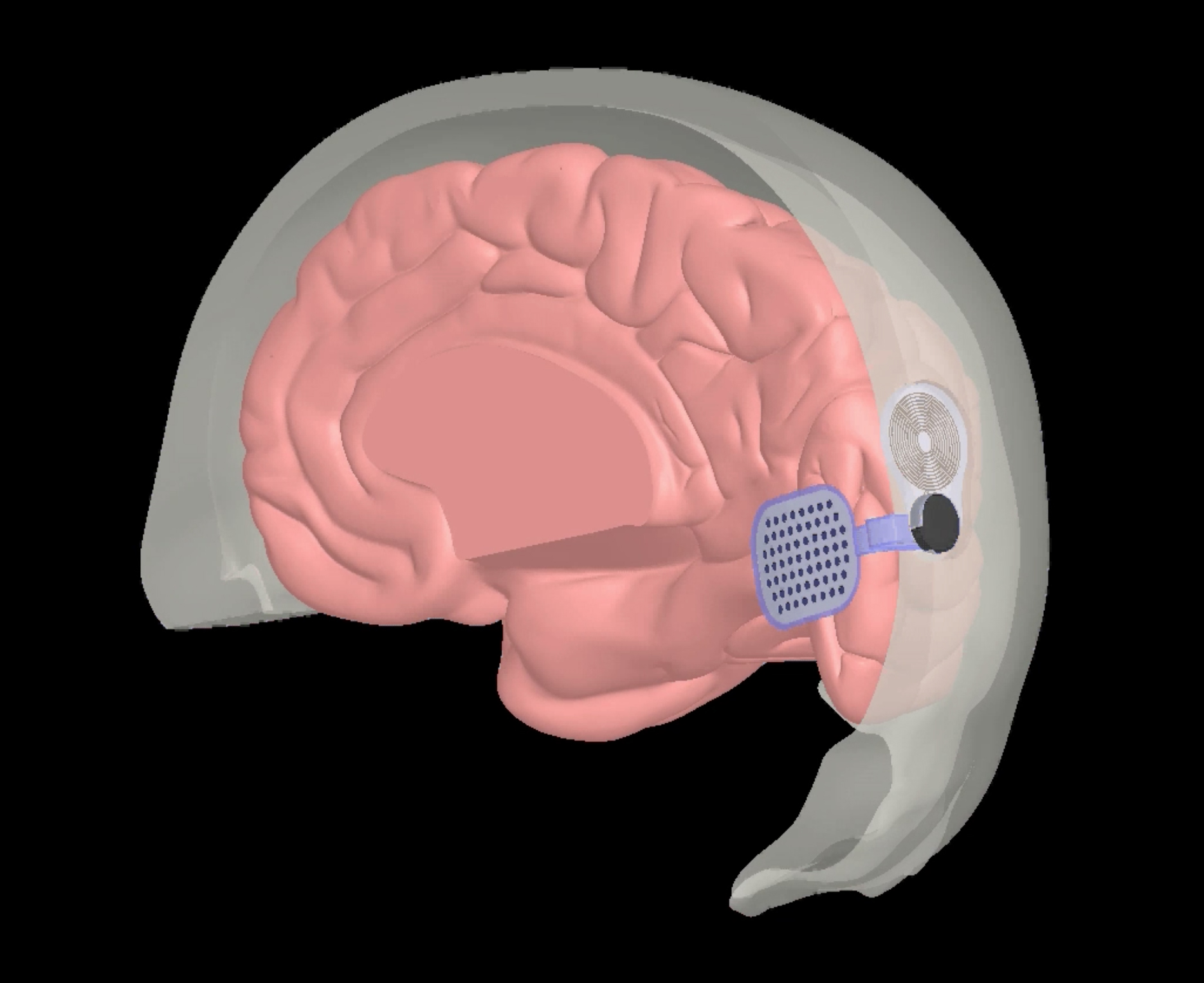 Un nuevo ojo biónico conectado al cerebro podría devolver la vista a más de seis millones de ciegos