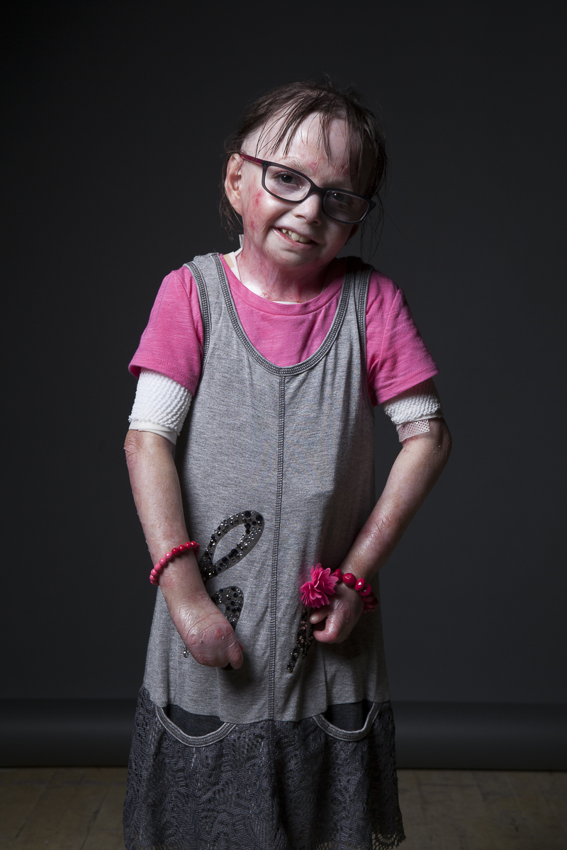 Un niño recupera su vida gracias a injertos de piel creados con terapia génica