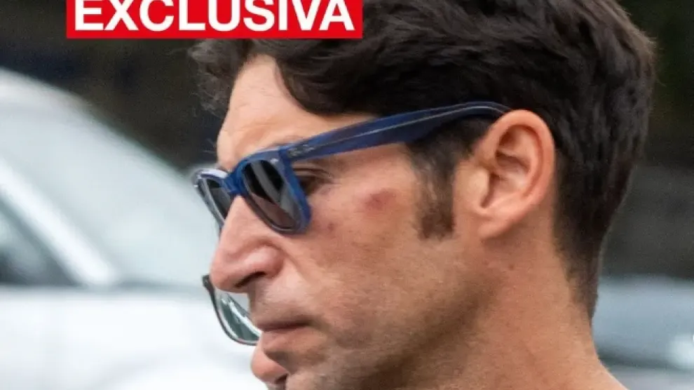 Primeras fotos de la salida del hospital de Cayetano Rivera mostrando golpes en la cara y una rodilla