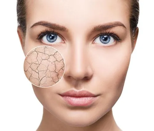 A woman with Dry Skin image