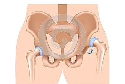 Hip Dislocation in Children: Causes, Diagnosis, and Management