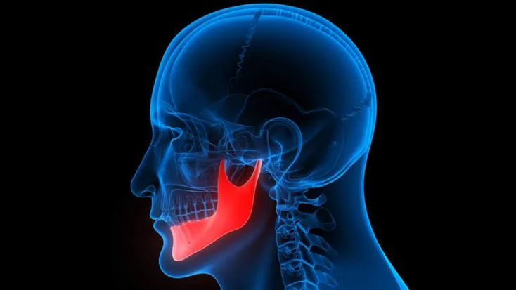 TMJ Disorder