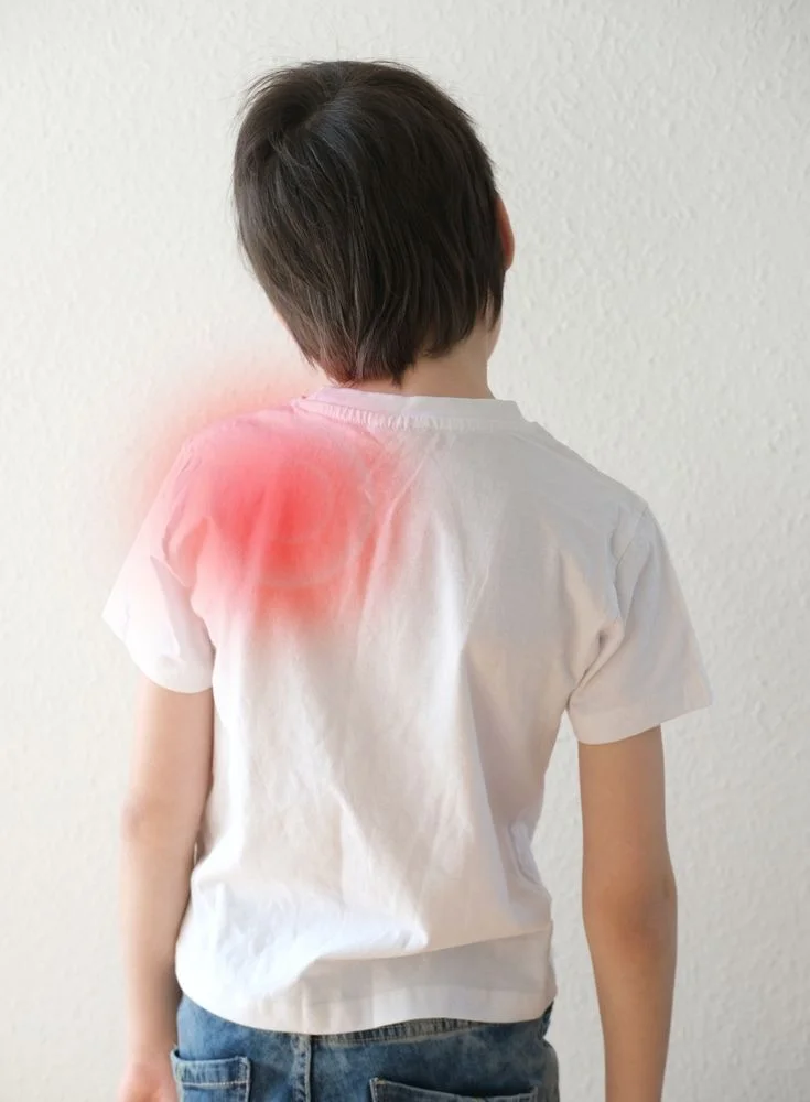 Erb’s Palsy (Obstetric Brachial Plexus Palsy)