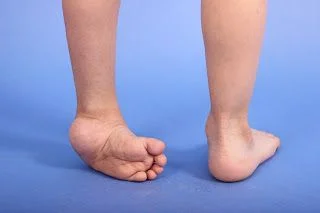  Clubfoot