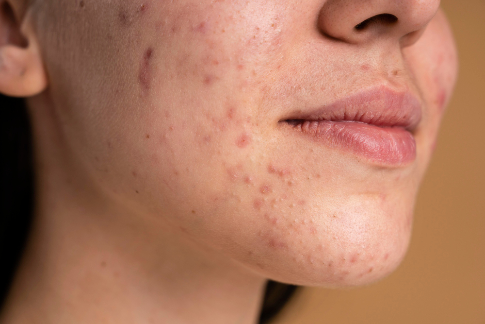 Acne Treatment