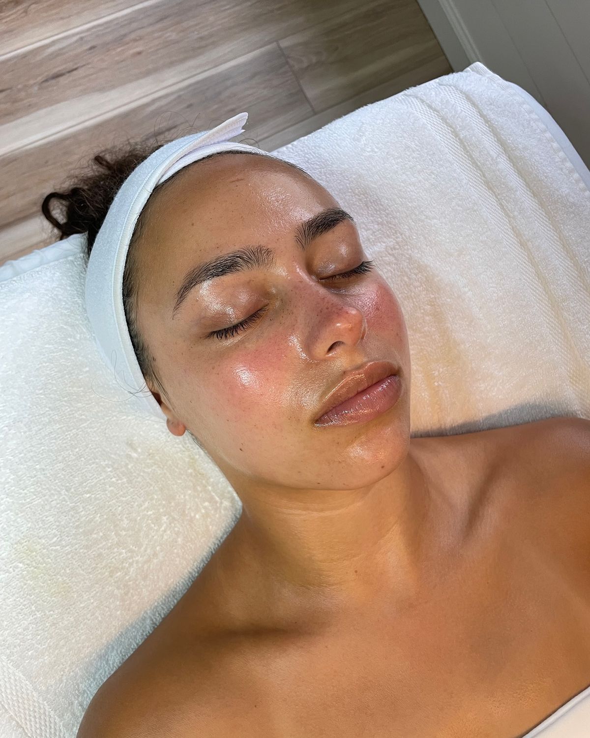 Microneedling Salmon DNA in Bedford, MA