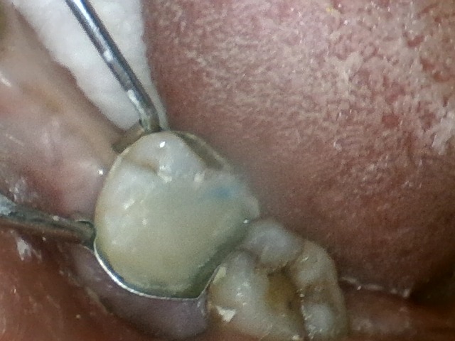 step 1